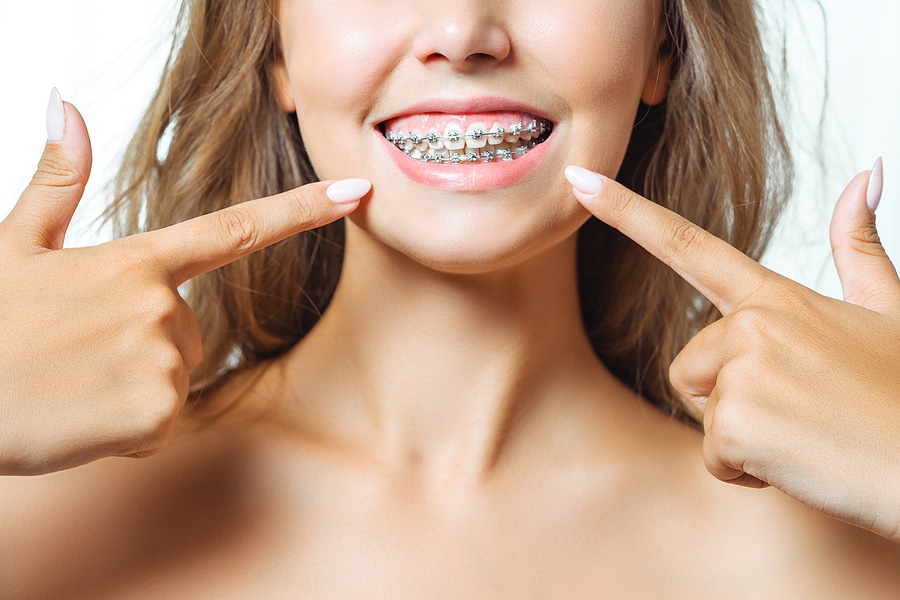 Braces: The New and Improved Way to Straighten Teeth
