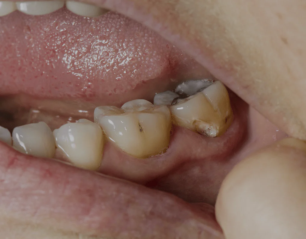 Factors That Shorten Tooth Lifespan