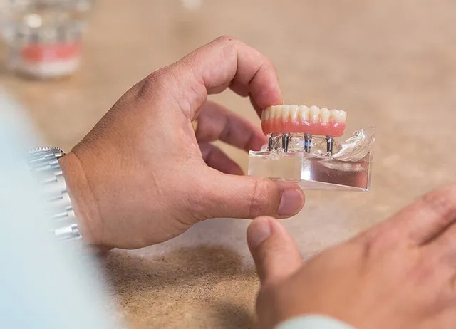 Replacing Multiple Teeth Through Implant Dentistry