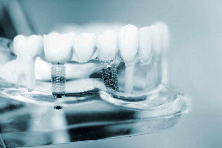 Dental Implants: What You Need to Know Before Getting One