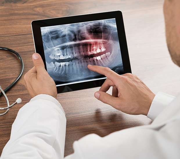 types-of-dental-root-fractures