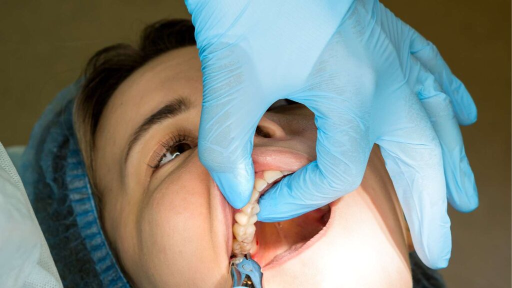 How Long Does Wisdom Teeth Surgery Take?