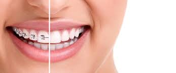 Is Tooth Extraction Necessary with Braces?