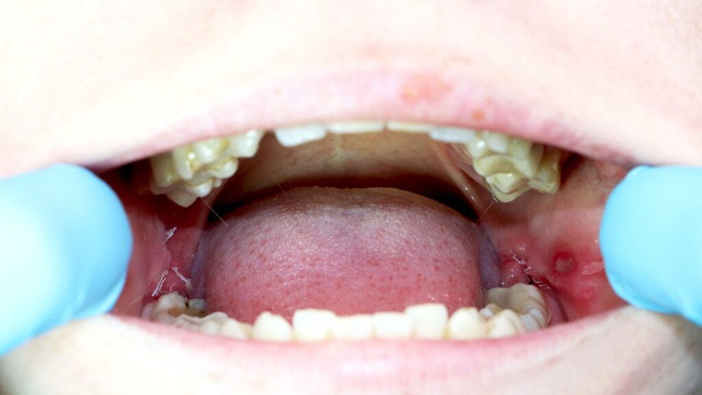 What Can You (and Can’t) Eat After Wisdom Teeth Removal?