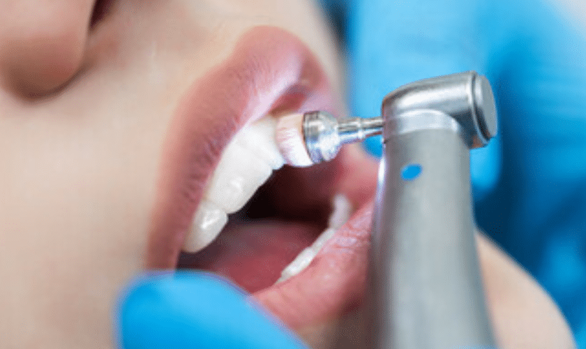 Do You Brush Your Teeth After Whitening Strips?