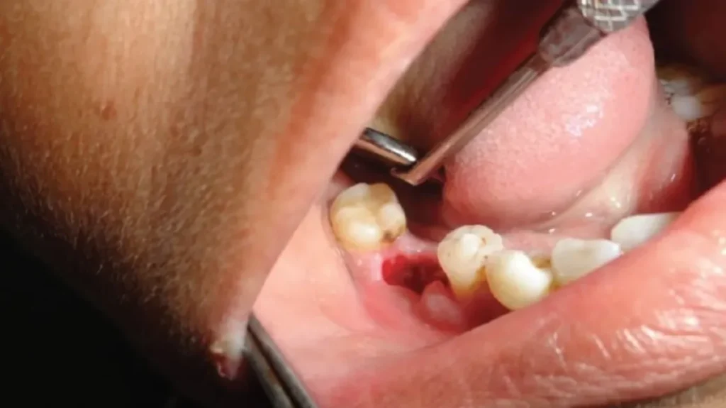 How to Speed Up Wisdom Teeth Recovery