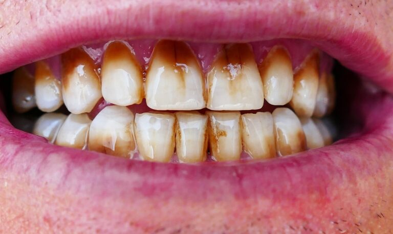 How to Remove Coffee Stains from Teeth