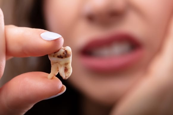 How to Speed Up Wisdom Teeth Recovery