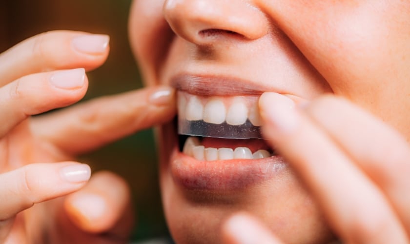 Do You Brush Your Teeth After Whitening Strips?