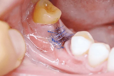 How to Speed Up Wisdom Teeth Recovery