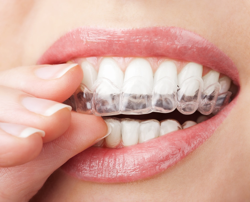 Do You Brush Your Teeth After Whitening Strips?