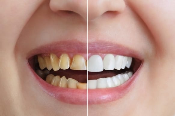 Why Are My Teeth Yellow When I Brush Them Every Day?