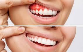 Advanced Periodontal Disease Treatment: Options When Teeth Are at Risk