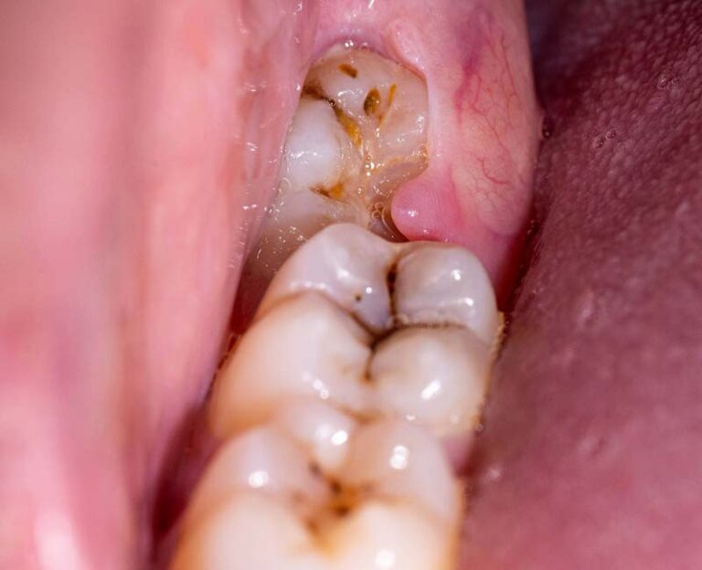 Can Wisdom Teeth Grow Back or Are They Completely Gone?