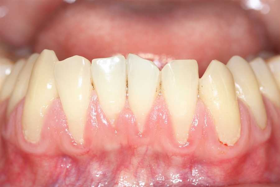 Gum Recession and Bone Loss: Are They Reversible?