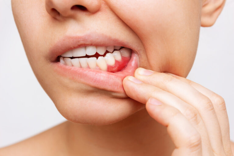 How Long Can You Keep Your Teeth with Periodontal Disease?