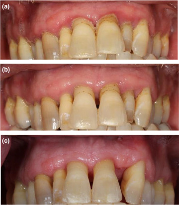 Long-Term Outlook: What to Expect When Managing Periodontal Disease