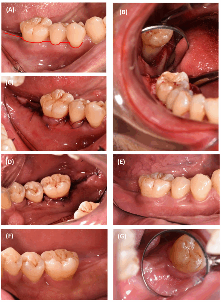Periodontitis Tooth Loss Timeline