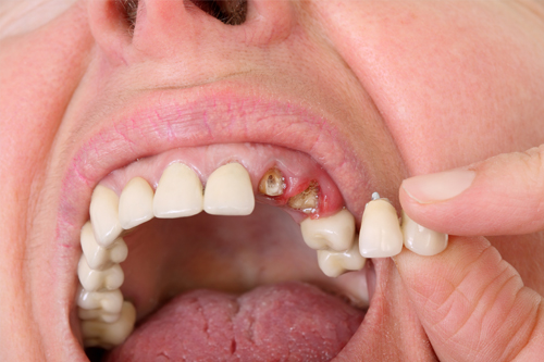 Preventing Tooth Loss from Periodontitis