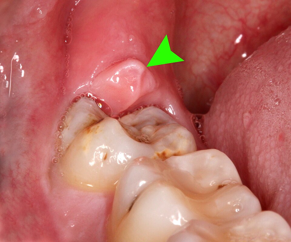 Tooth Retention with Gum Disease: What You Need to Know