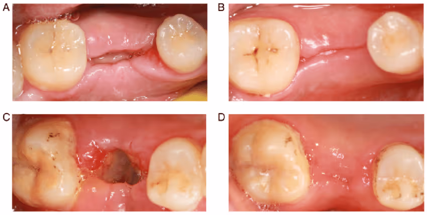 Wisdom Teeth Healing Stages: How Your Body Recovers