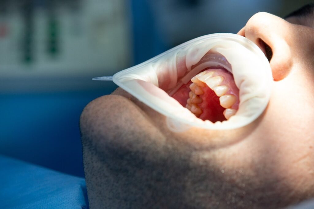 Dental Cleaning Process Step-by-Step
