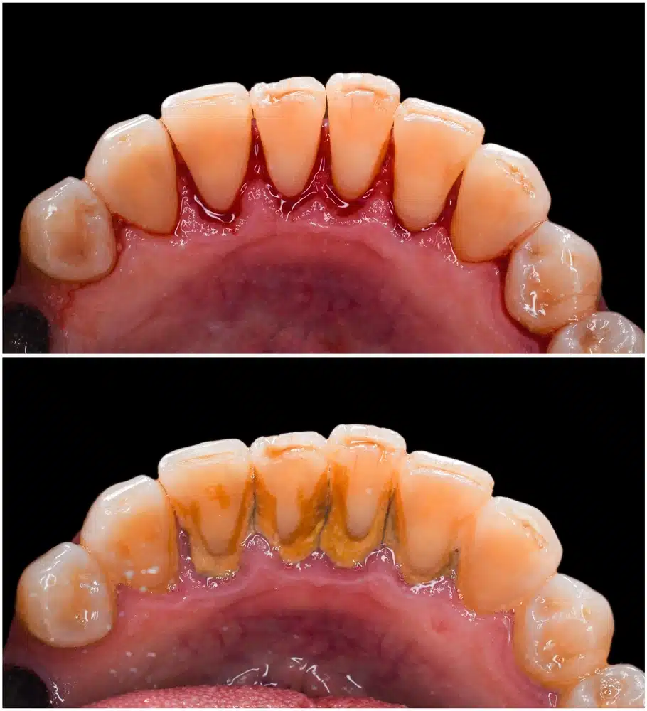 What’s the Difference Between a Regular Dental Cleaning and a Deep Cleaning?