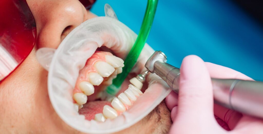 Why Dental Cleanings Matter for Long-Term Oral Health