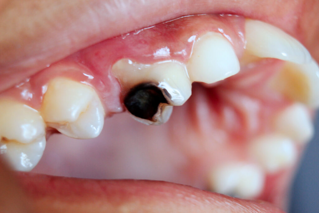 Can Cavities Heal on Their Own Without Fillings?