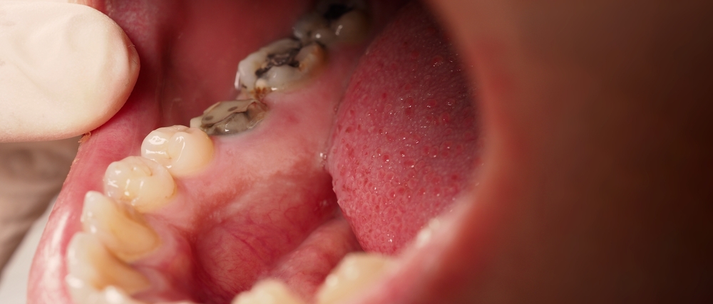 Can Cavities Heal on Their Own Without Fillings