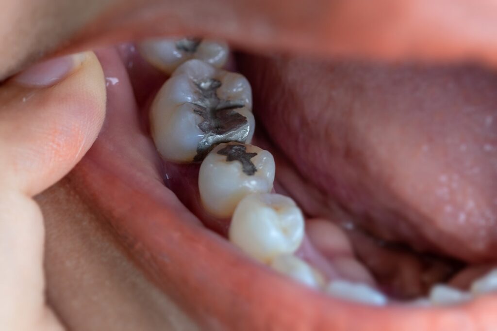 Can Cavities Heal on Their Own Without Fillings