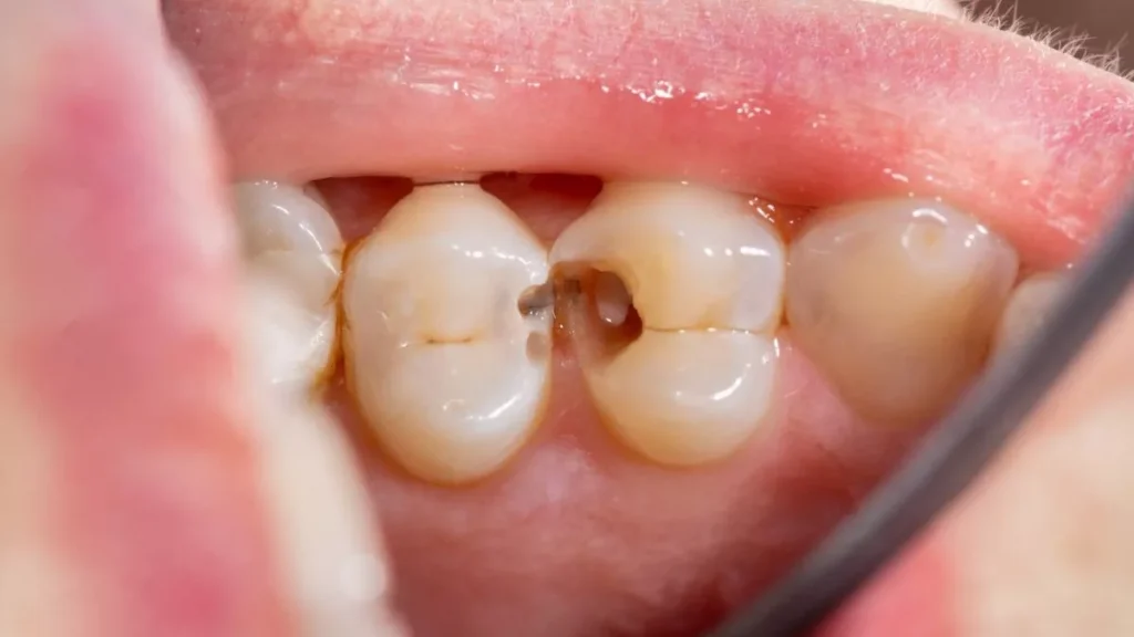 Can Cavities Heal on Their Own Without Fillings