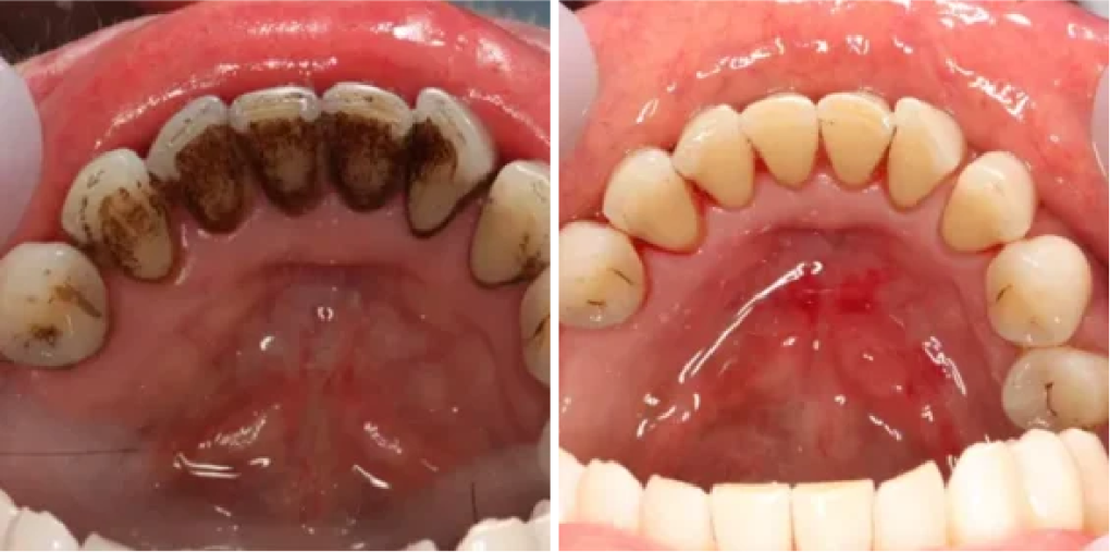 What Happens If You Skip Dental Cleanings for a Year