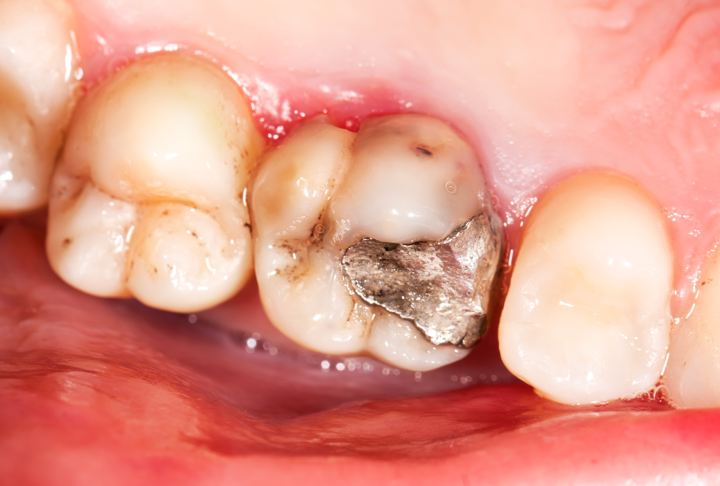 Can Cavities Heal on Their Own Without Fillings
