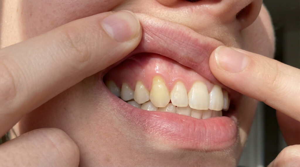 Stages of Gum Recession and Tooth Loss Risk