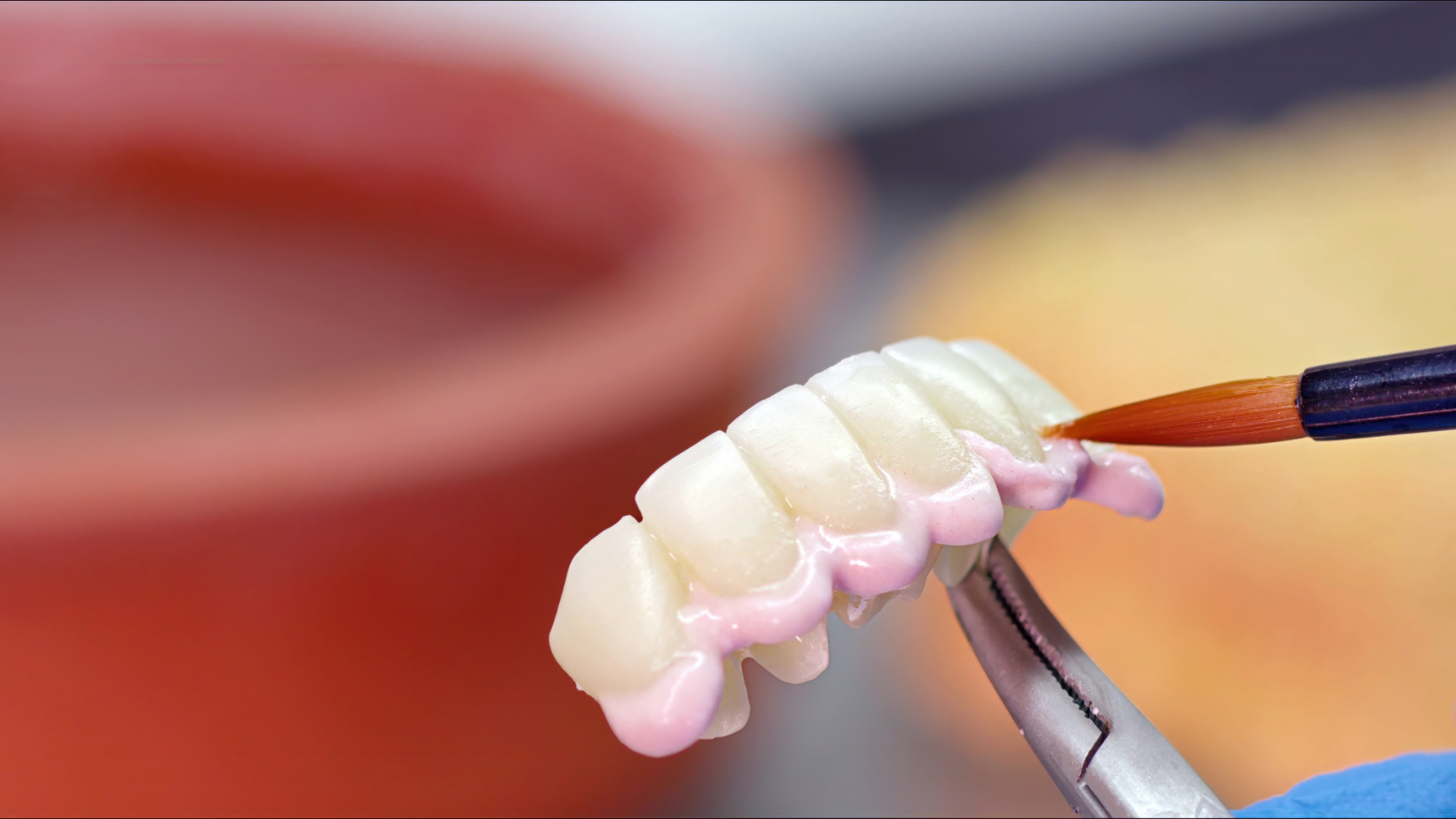 A picture of a fixed porcelain bridge- naccid, buford dentist, ga