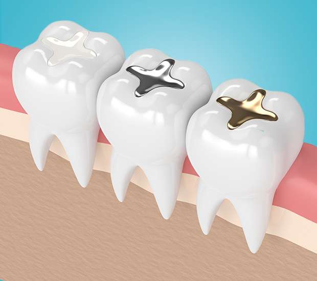 Buford Tooth Colored Fillings