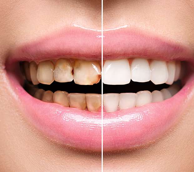 Buford Dental Implant Restoration