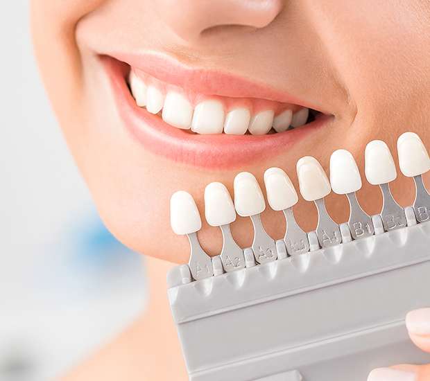 Buford Veneers