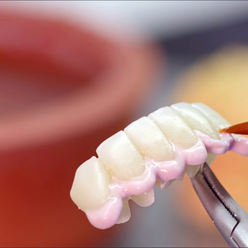 A picture of a fixed porcelain bridge- naccid, buford dentist, ga