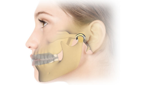 How Long Does TMJ Last, and Does It Go Away on Its Own?