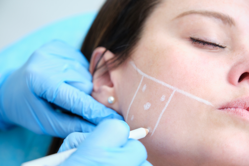 Marking the jaw for Botox for Bruxism