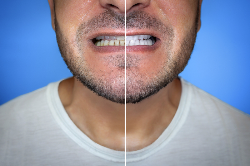 NACCID Smile Makeover Trends before and after of a man who got a smile makeover