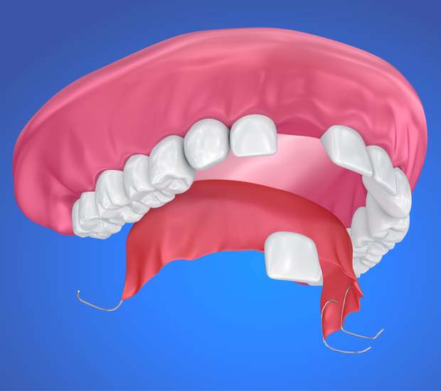 Buford Partial Denture for One Missing Tooth
