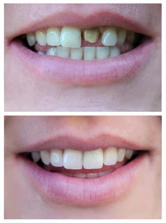 Full mouth reconstruction before and after images showcasing stunning smile transformations