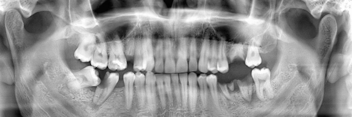 Buford Wisdom Teeth Extraction